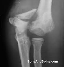 Medial epicondyle fractures represent almost all epicondyle fractures and occur when there is avulsion of the medial epicondyle.they are typically seen in children, and can be challenging to identify. Distal Humerus Fracture Bone And Spine