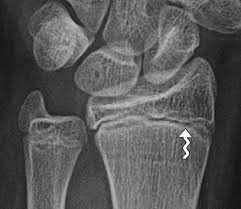 Long Bone By Thirumurugan M Professor Msc | Pdf