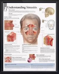 Understanding Sinusitis Chart 22x28 Sinus Infection