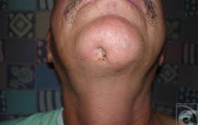 Likewise, you should know what the spider looks like. Brown Recluse Spider Bites Symptoms And Pictures