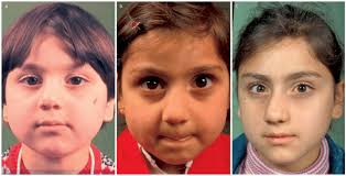 Minor infections at the opening of the nose may result in pimples at the base of nasal hairs (folliculitis) and sometimes crusts around the nostrils. A 5 Year Old Girl With Minimal Deviation Of The Nose Due To Nasal Download Scientific Diagram