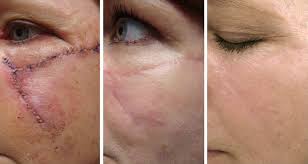 Scar Revision With Sciton ProFractional® Laser in Medford, OR | Pure Medspa