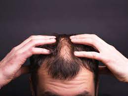 In addition, they share some similar signs and symptoms, such as red, scaly skin. Psoriasis And Hair Loss Causes Symptoms Treatment
