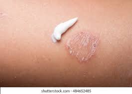 Image result for erysipel photos)