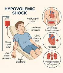 Shock | Tirath Ram Shah Hospital