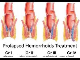How To Treat Prolapsed Internal Hemorrhoids Stop Suffering Instantly Cure For Hemorrhoids Hemorrhoids Treatment Hemorrhoids