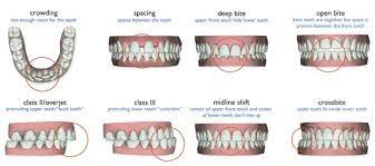 Three Options To Straighten Your Teeth Teeth Straightening Teeth Dentist