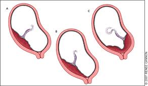 It can be a sign of a threatened miscarriage, he said, which is. Late Pregnancy Bleeding American Family Physician