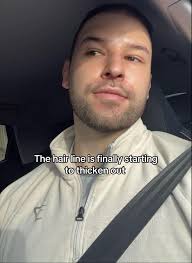 James Hair Loss