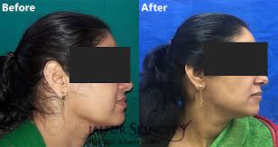 permanent laser hair removal treatment
