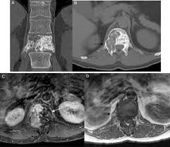 Learn how cancer spreads, possible symptoms, common sites where cancer spreads, and how to find out about treatment options. Tumores Primarios De Columna Sciencedirect