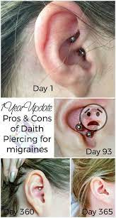 Migraine Piercing 1 Year Results Migraine Piercing Daith Piercing Migraine Migraines Remedies