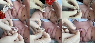 Image result for Neonatal Circumcision