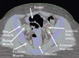 The pelvic floor muscles provide foundational support for the intestines and bladder. Axial Computed Tomography Ct Slice Through The Mid Pelvis In An Download Scientific Diagram