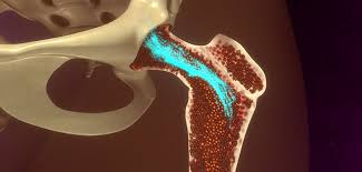 What is cancer of bone marrow. What Is Bone Marrow Cancer Apollo Hospitals Blog