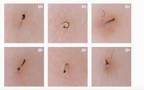 How to get rid of public ingrown hair. Tweezist Instagram Account Shows Ingrown Hairs Being Extracted Allure