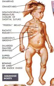 Profilaxia Rahitismului Pediatru Cluj