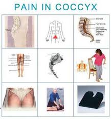 Pin On Coccyx Pain