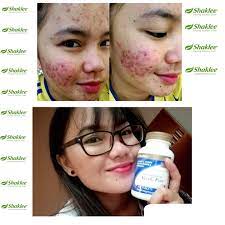 Ia juga berfungsi untuk memutihkan kulit dan menghalang penuaan kulit muka. Vitamin Shaklee Untuk Jerawat Bernanah Besar Jerawat Pasir Parut Jerawat Pengedar Shaklee Shah Alam