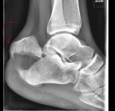 Image result for Calcaneus Compression Fracture