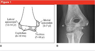 A medial epicondyle fracture is an avulsion injury of the attachment of the common flexors of the forearm. Medial Epicondyle Fractures In The Pediatric Population Semantic Scholar
