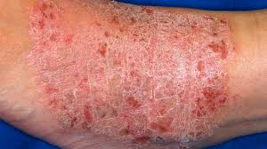 If the wound or scratch is bleeding, cover it with a clean cloth and apply pressure for 2 or 3 minutes until the bleeding stops. Lichenification Pictures Symptoms And Treatment