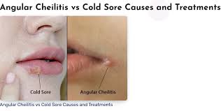 Image result for Angular Stomatitis