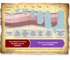 Image result for Bladder Cancer Staging