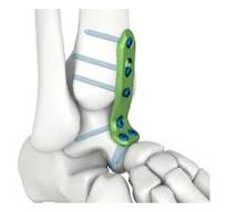 Ankle Fusion Locking Plate,small,Medical Device Manufacturers
