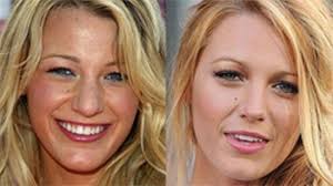 Blake Lively Nose Job Plastic Surgery Blake Lively Plastic Surgery Celebrity Plastic Surgery Blake Lively Nose