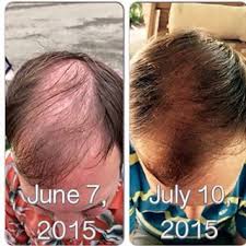 Biotin Hair Growth Before And After Pictures Men Before After Hair Regrowth For Men On The Monat System Learn More At Http Kimwalden Mymonat Com Hair Growth For Men Monat Hair Hair Loss Men
