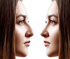 Rhinoplastik ist eine art von operation, um probleme an der nasenspitze zu korrigieren, ohne knochenstrukturen zu ändern oder zu brechen. Nasenkorrektur In Winterthur Zurich Clinic Plastica