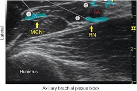Image result for Axillary Nerve Block