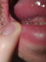 Sie machen sich besonders bemerkbar, wenn sie mit säurehaltigen. Pickel Warze Unter Der Zunge Denta Beaute