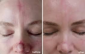 Understanding the symptoms and the risks associated with each type of skin cancer will help you determine the right course of treatment. Minimising Scarring Post Bcc Removal Skin Cancer Courses Blog