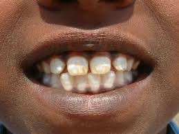 First, it's important to know that enamel damaged by decay cannot simply grow back. Study Reveals How Too Much Fluoride Causes Defects In Tooth Enamel Mirage News