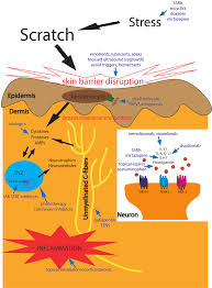 Image result for Lichen Simplex Chronicus