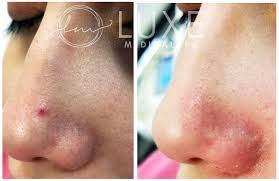 They are considered to be painless and harmless. Cherry Angioma Veingogh