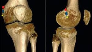 The medial epicondyle of the femur is a bony protrusion located on the medial side of the bone's distal end. Difference Between Condyle And Epicondyle Youtube