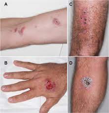 What is the natural habitat of sprothrix schenckii? Cases Of Sporotrichosis A Lymphocutaneous Spread From Cubital Fossa Download Scientific Diagram