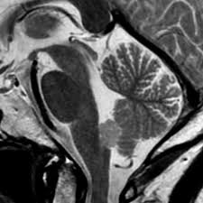 Subependymoma Radiology Case Radiopaedia Org Radiology Medical Illustration Diagnostic Imaging