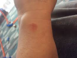 Can you get a rash from wearing a smartwatch? Burn Rash From Apple Watch 2 Help Apple Community