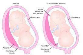 Schematic Diagram Comparing Normal Placenta Left And Circumvallate Placenta Right The Membranes Insert At The Edge Of The Norm Placenta Placental Membrane