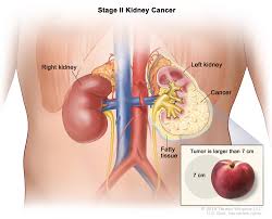 Renal Cell Cancer Treatment Pdq Patient Version