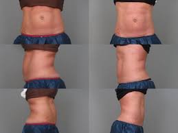 Look At Our Patient S Coolsculpting Results After 1 Month No Downtime Involved These Pictures Are Proof That It Really W Cool Sculpting Workout After Workout