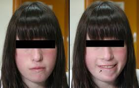 Adolescente con síndrome de deleción 22q11.2 y endocrinopatía múltiple