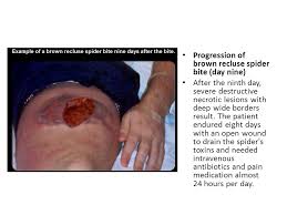 Mild to intense pain and itching for 2 to 8 hours following the bite. Brown Recluse Bite Ppt Video Online Download