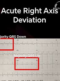 Image result for Right Axis Deviation