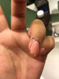 I've read numerous articles from people who have received gel nails, and i'm shocked to the core about some of the stories. Hit My Acrylic Nail Resulting In Lifting My Real Nail And I Believe Pushing The Nail Bed To Skin Nail Disorders Forums Patient