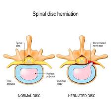 However, the spinal erectors travel the length of the entire spine. Lower Back Muscle Anatomy And Low Back Pain